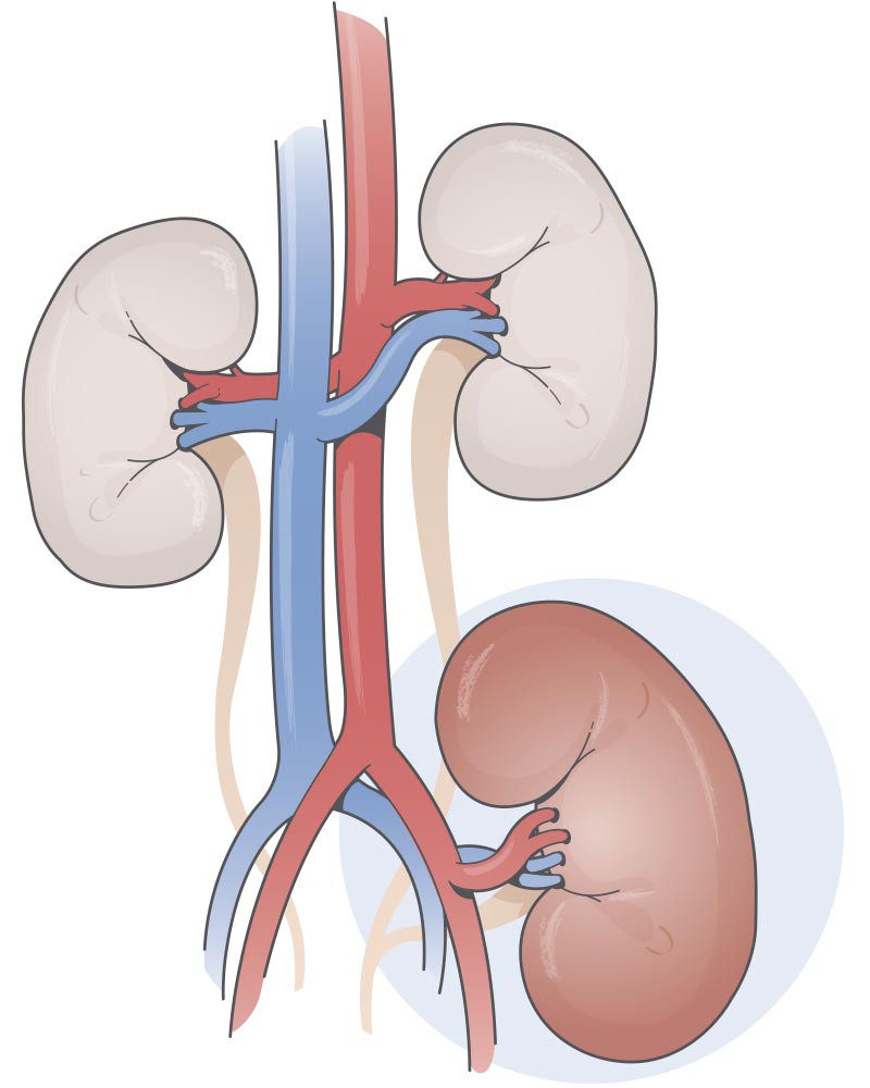 Diagrama de un riñón trasplantado